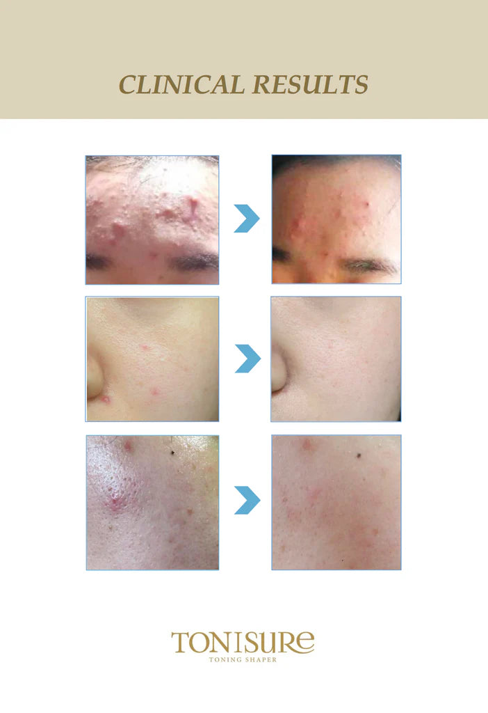 Clinical results of a skincare treatment by Tonisure on various skin conditions.
