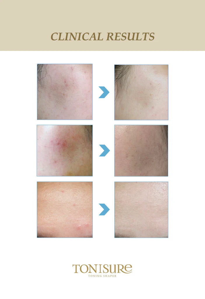 Tonisure- Plasma & Galvanic